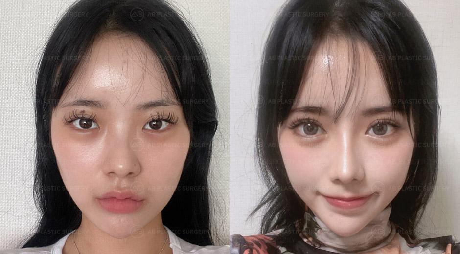 I was worried about the revision surgery for my eyes, but I'm satisfied with the elegant outcome.