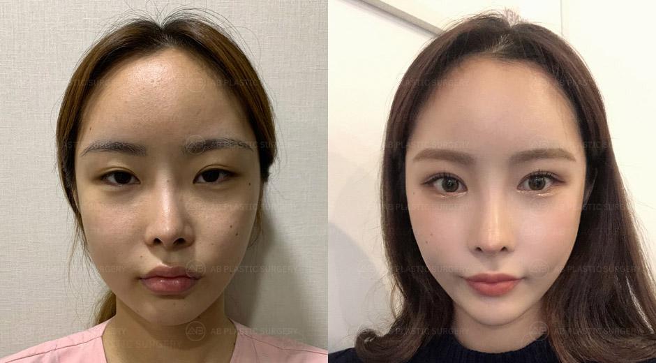 I had revision surgery for my eyes and nose at AB Plastic Surgery.