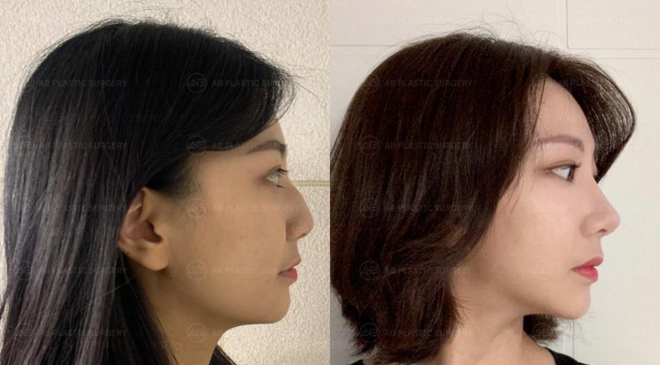 I had a hump nose surgery also known at AB Plastic Surgery.