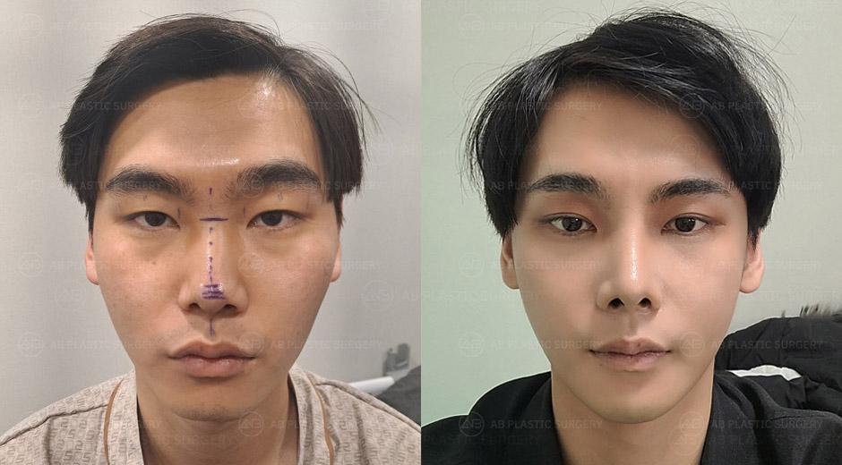 It's definitely a much more defined face compared to pre-surgery.