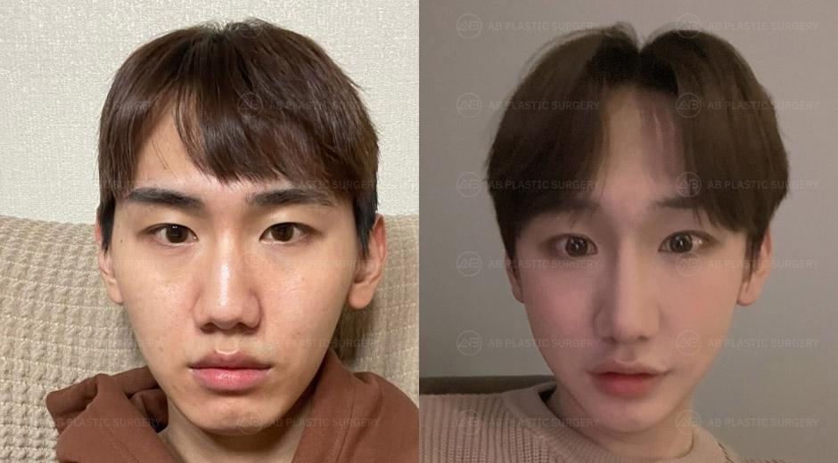 I have completed the cosmetic surgery with a great-looking face and without any side effects.