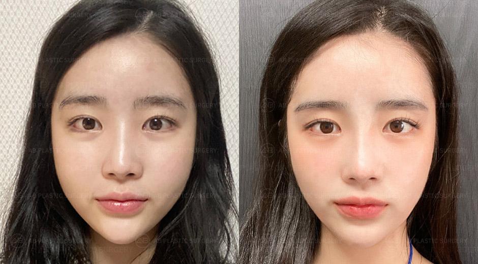 If I were to have another surgery, I would still choose AB Plastic Surgery to do it.