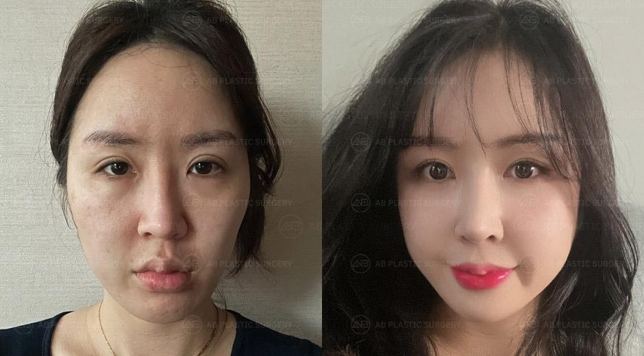 The double eyelid revision surgery and rhinoplasty looks very natural!