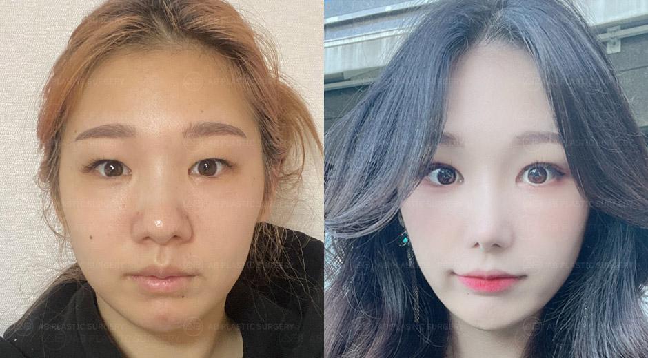 It was the perfect plastic surgery for me.
