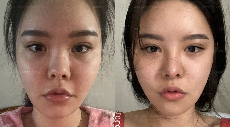 I highly recommend AB Plastic Surgery to my friends.