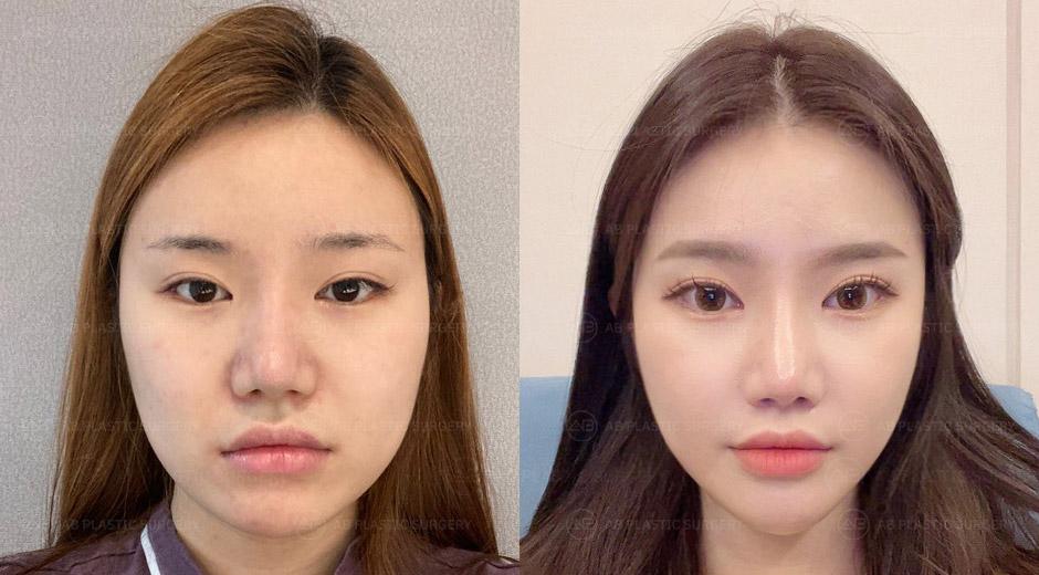 I had surgery at AB Plastic Surgery, and now I'm working there as an employee.