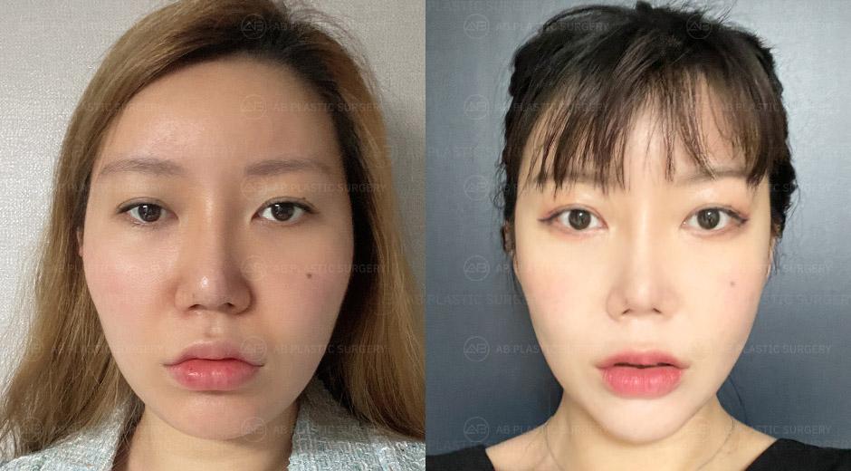 After facial contouring surgery, my face became smaller.