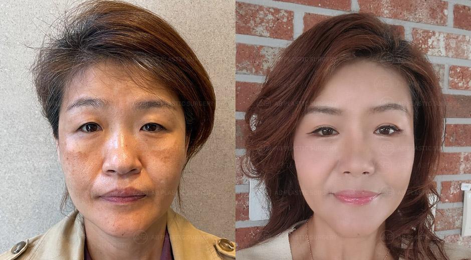 AB Plastic Surgery made me look 10 years younger.