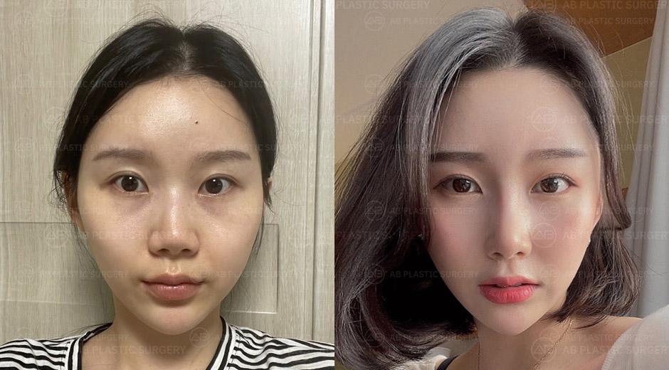 After double eyelid surgery, I don't have to wear heavy eye make up anymore.