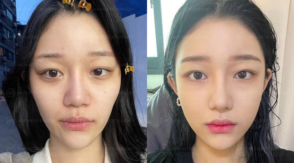 The plastic surgery turned out so well, that many of my friends also choice AB for surgery.