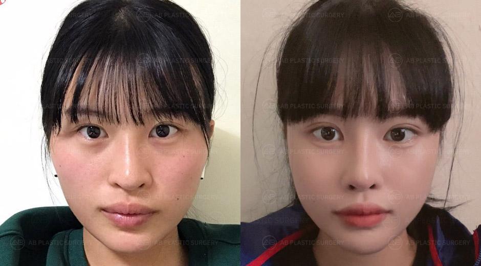 I can't believe I didn't do the plastic surgery earlier. I think I made the right decision, and I'm very satisfied with the results.