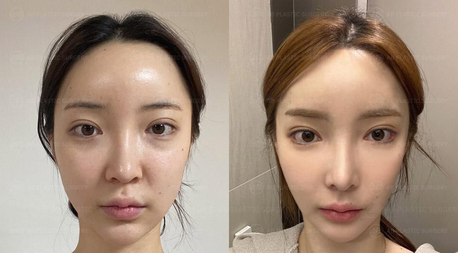 Facial Contouring All 3-Set, Rhinoplasty Revision (Donated Rib Cartilage, Nostril Reduction), Forehead Reduction