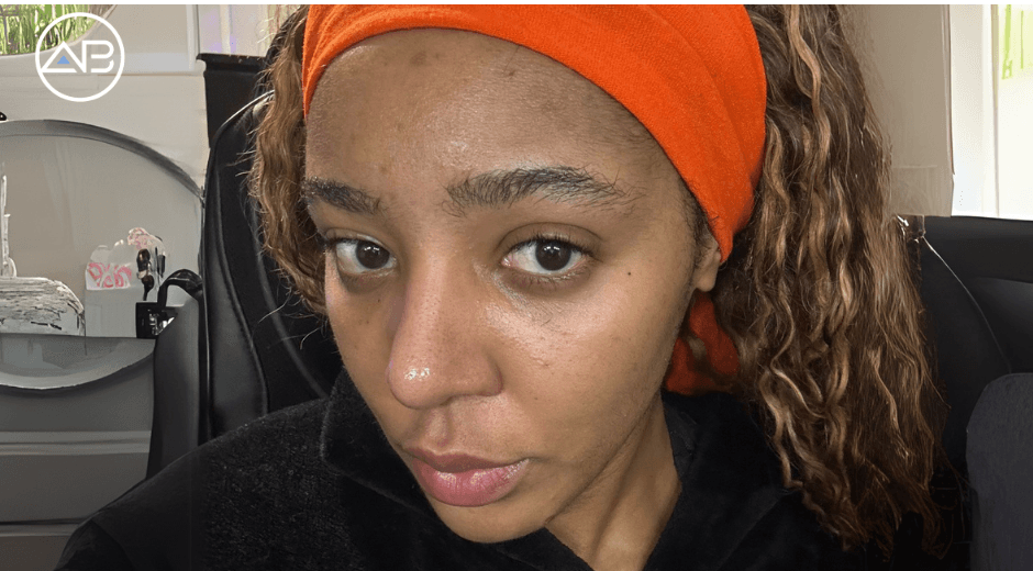 Ethnic Rhinoplasty Success: A Natural-Looking Result That Perfectly Complements My Features!