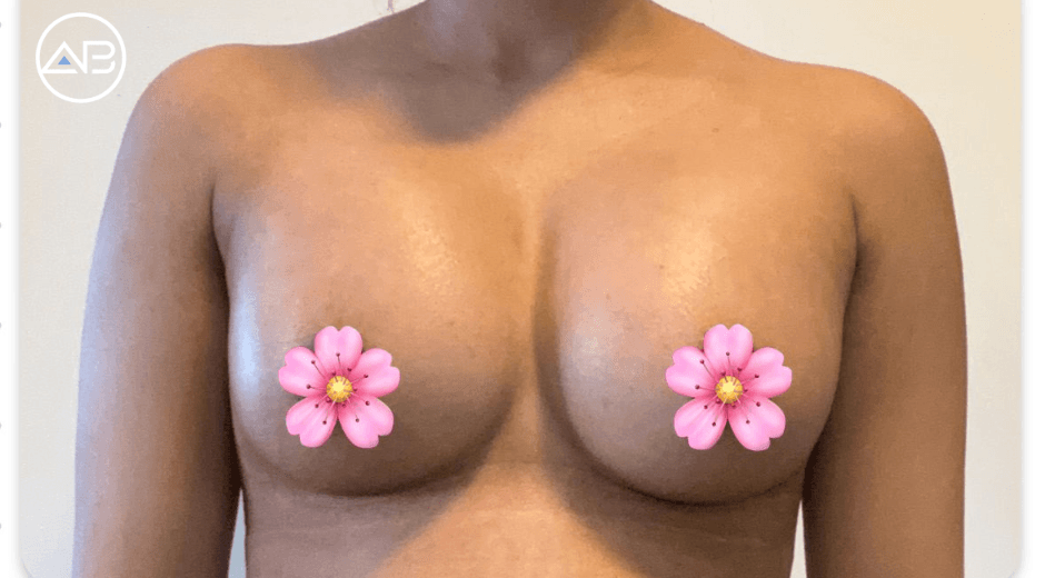 A Confidence Boost Like Never Before: My Breast Augmentation Journey