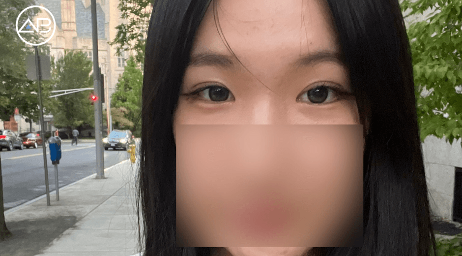 From Consultation to Confidence: My Seamless Double Eyelid Surgery Experience as a First-Time Foreigner in Korea