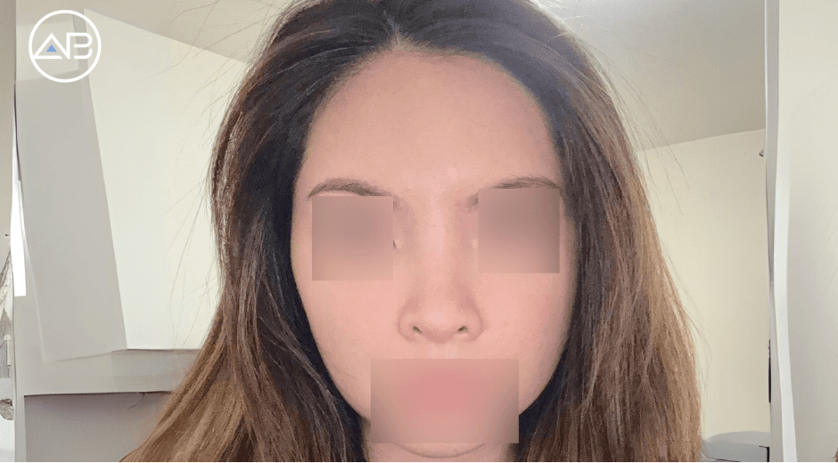 One Month Post-Op Update – My Transformation Journey!