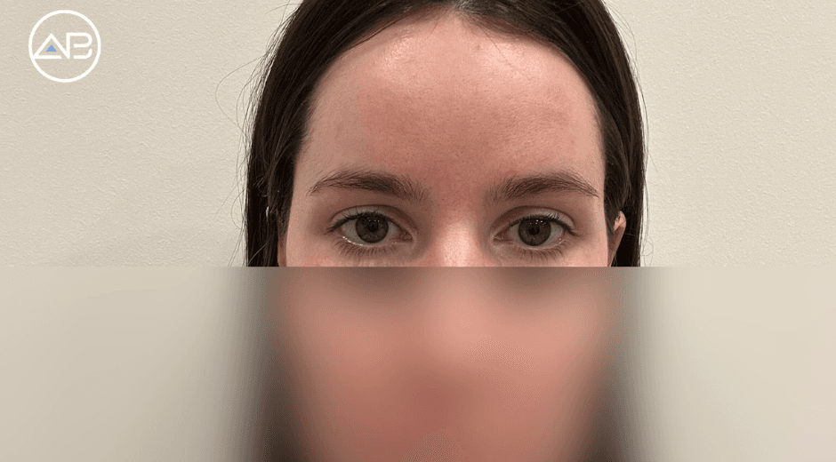 Unmatched Care and Incredible Results of My Forehead Lifting