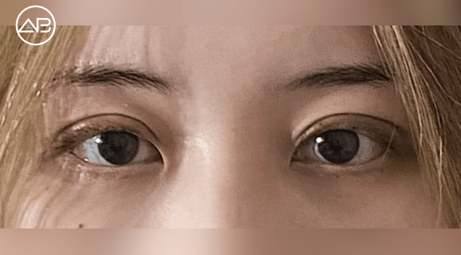 My experience of getting incisional double eyelid surgery - 1 month post-op