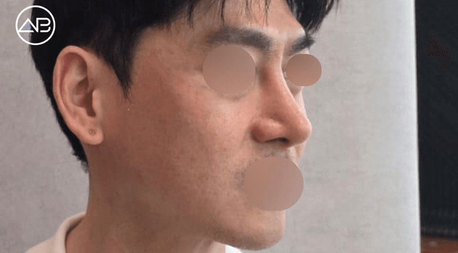 I had my rhinoplasty done at AB.