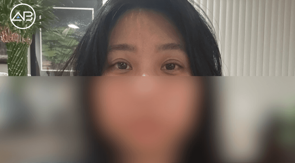 Thoughtful Care & Expertise: My Positive Experience with Revision Blepharoplasty in Gangnam