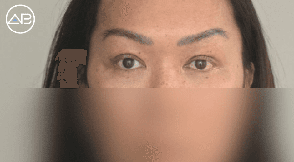 Revision eyelid in Korea for the first time!