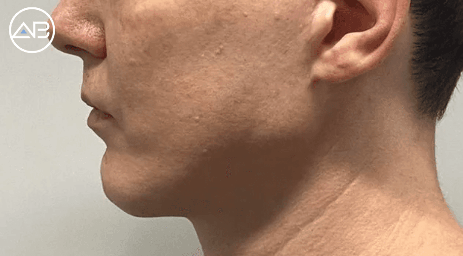 Custom chin/jaw implant from AB Plastic Surgery, Seoul