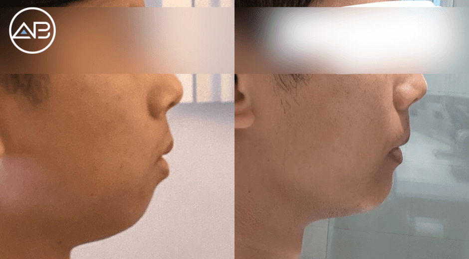 My sliding genioplasty experience at AB Plastic Surgery