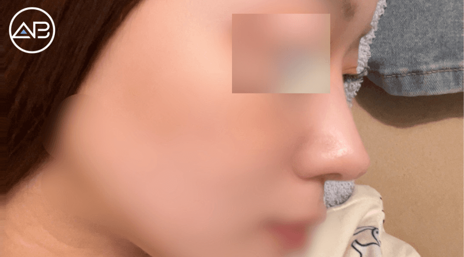 9 Months Post-Op Rhinoplasty at AB Plastic Surgery