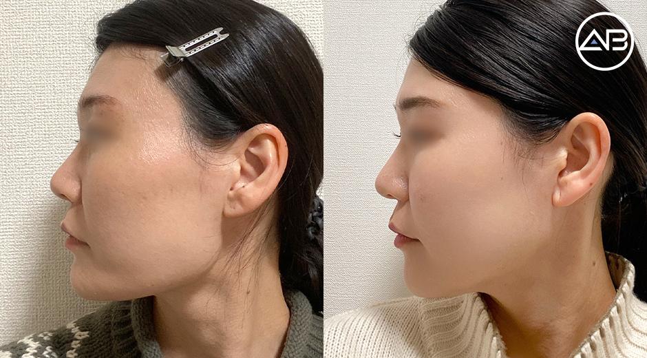 My Facial Contouring Journey at AB