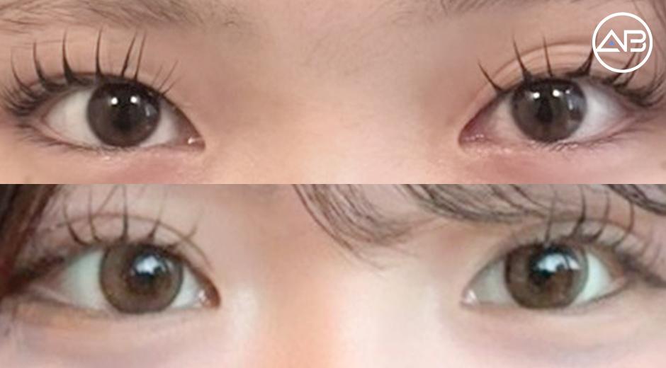 Double Eyelid (Non-Incisional) Surgery in Mid Feb