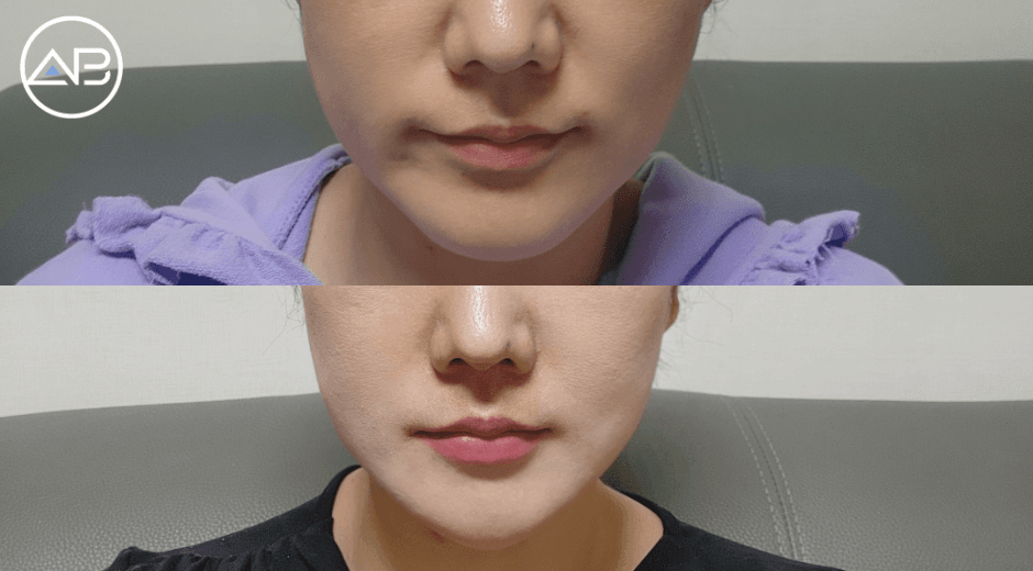 Got my philtrum done!