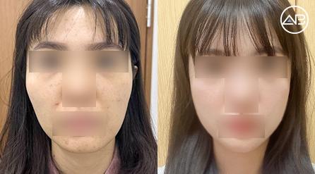 Life After Bone Contouring: 2-Month Post-Op Review