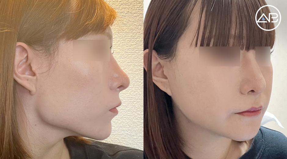 Friends Said WOW! My 3-Point Facial Contouring Result
