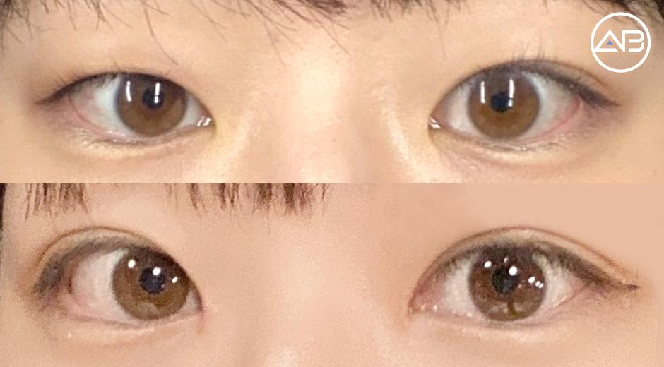 Why I’m Glad I Chose AB Plastic Surgery 🤍