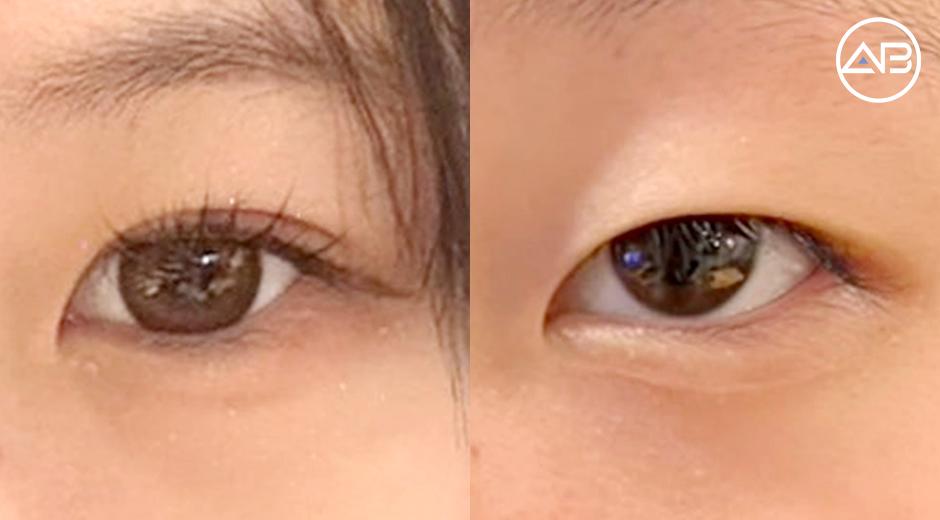 My Double Eyelid Surgery Experience in Korea