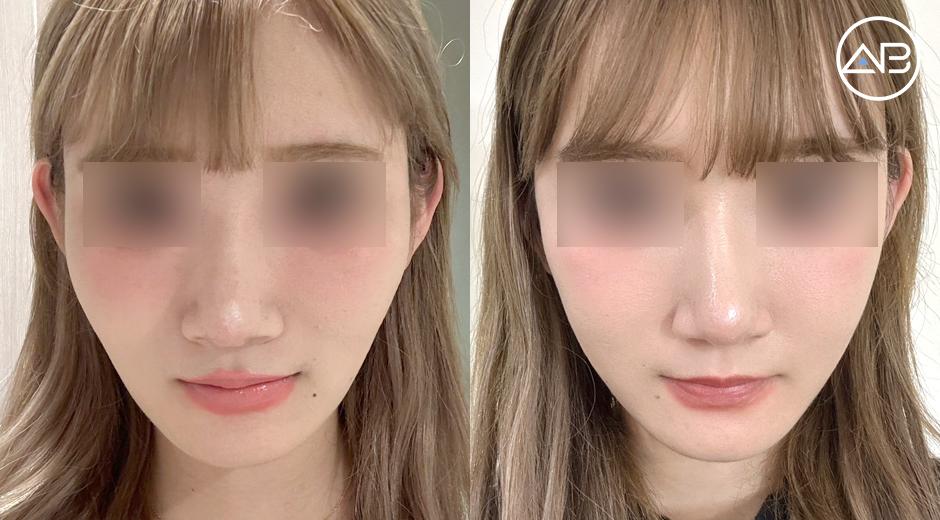 Two Months After My Zygoma Reduction Surgery!