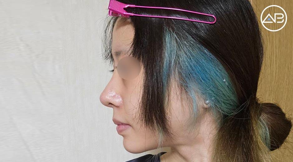 Nose job in Korea! My first!