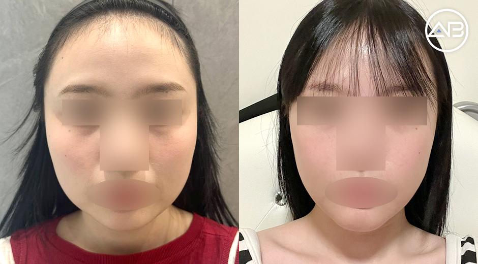 Korean Facial Contouring Experience Sharing