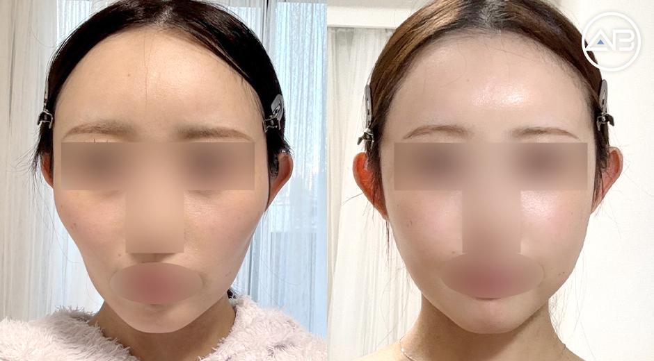 Makeup Has Become So Much More Fun After My Facial Bone Surgery