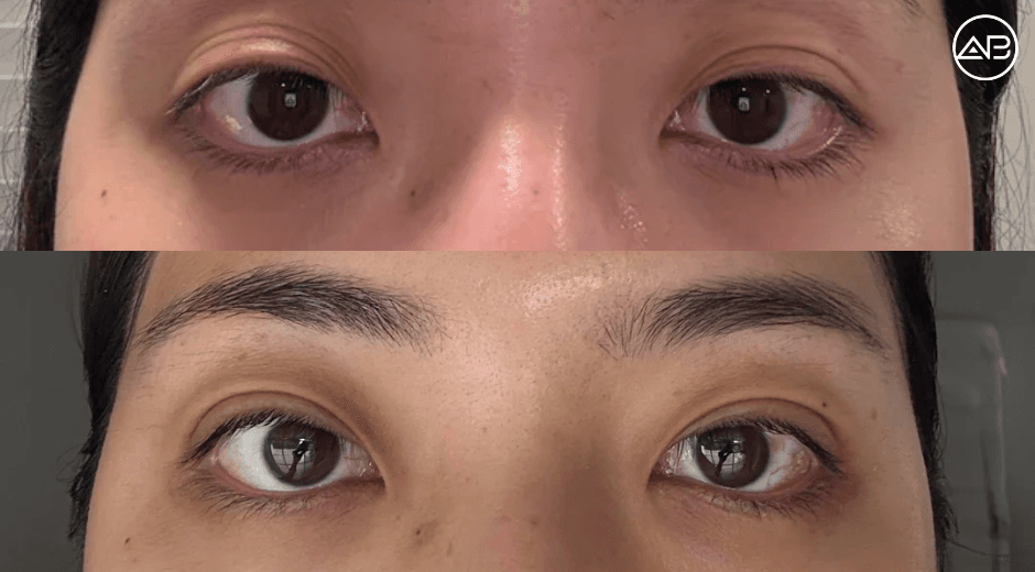 Double Eyelid Surgery Review - 1 Month Post OP