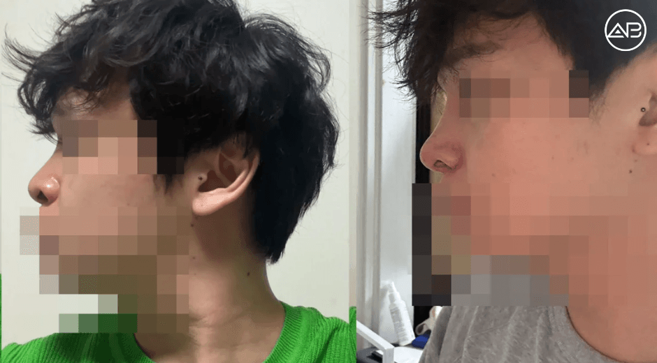 My first Rhinoplasty - 1 month Post Op review