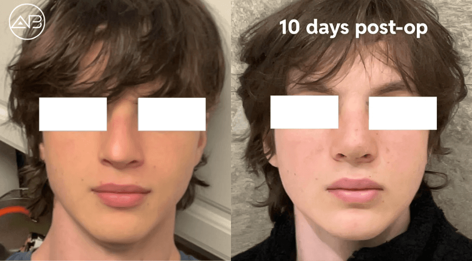 My Rhinoplasty Experience with AB Plastic Surgery