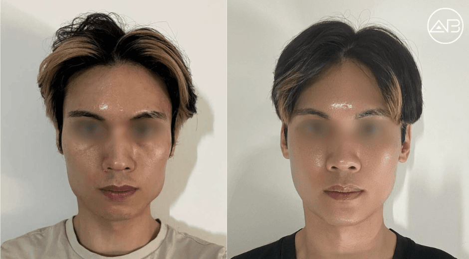 3set Contour + Fat Grafting