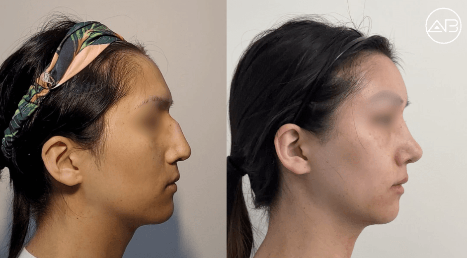 1.5 months post facial surgery with AB Plastic Surgery