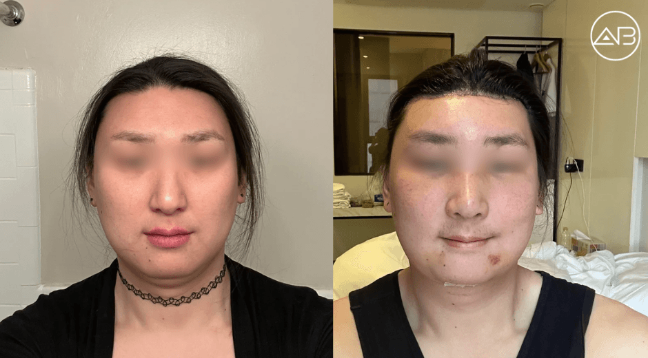 My FFS in Korea (AB Plastic Surgery)