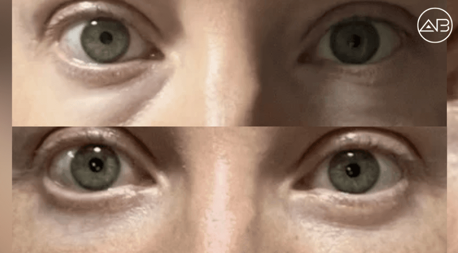 Lower Blepharoplasty Procedure