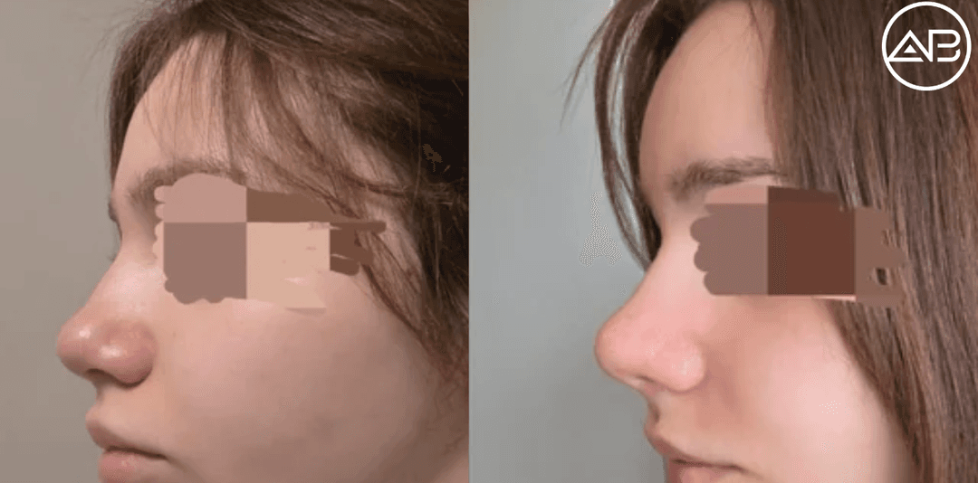 Rhinoplasty and fatgrafting at Ab clinic gangnam