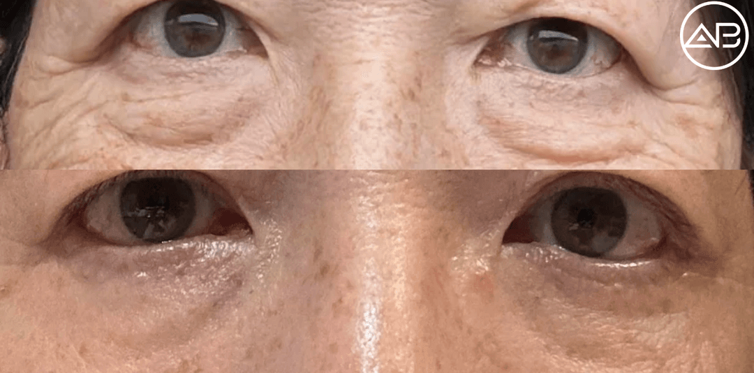 AB Plastic Surgery lower blepharoplasty review