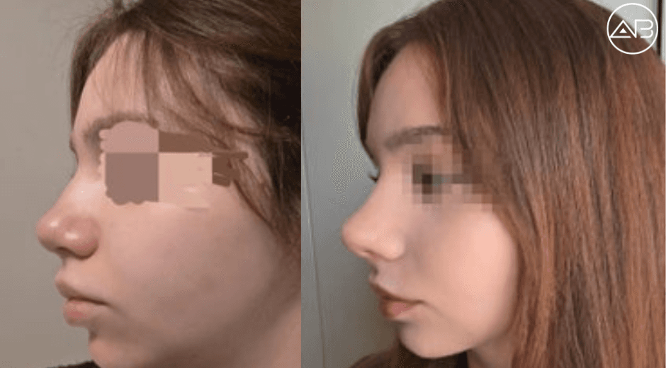 Rhinoplasty at AB