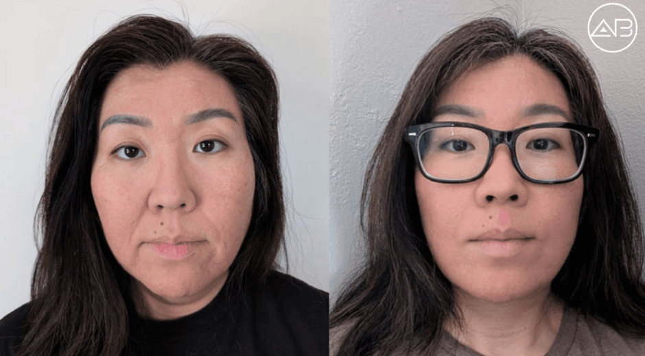 V Line Surgery and Facial Contouring Experience at AB Plastic Surgery